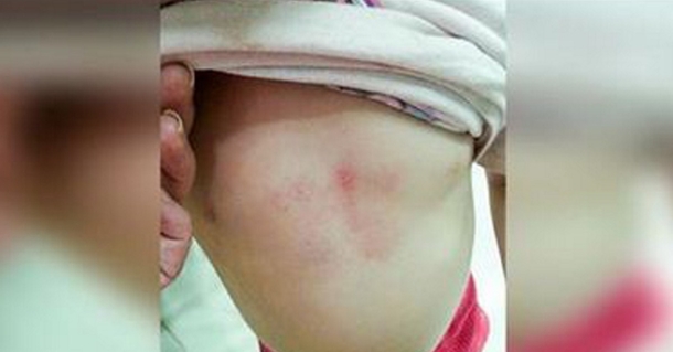 This Toddler Has Bruises On Her Chest. The Reason Why? This Is