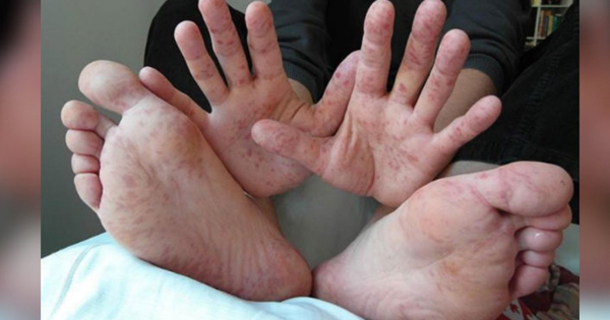 Doctors Warn HFM Disease Is On The Rise, Spreading Quickly. What They