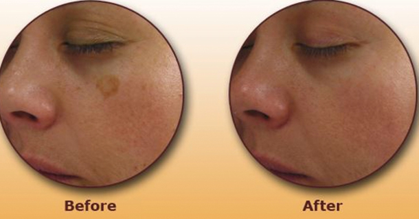 Try This Simple Trick to Get Rid of Brown Spots on Face & Skin