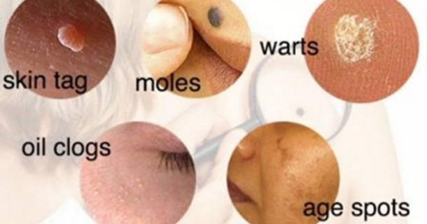 This Is How To Remove Moles, Warts, Blackheads, Skin Tags