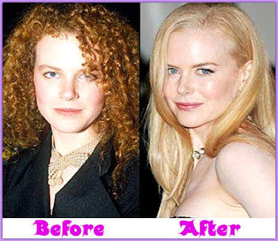 before and after surgery- Nicole Kidman facial surgery before and after surgery- Nicole Kidman facial surgery