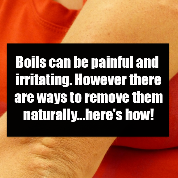 Boils can be painful and irritating. However there are ways to remove them naturally...here's how!