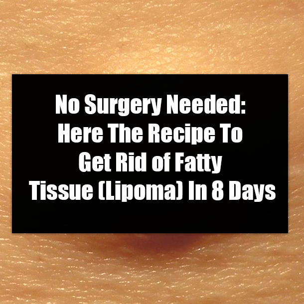 No Surgery Needed: Here The Recipe To Get Rid of Fatty Tissue (Lipoma) In 8 Days