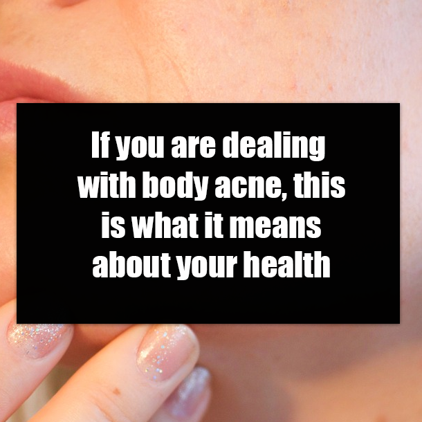 If you are dealing with body acne, this is what it means about your health