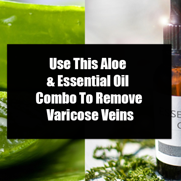 Use This Aloe & Essential Oil Combo To Remove Varicose Veins