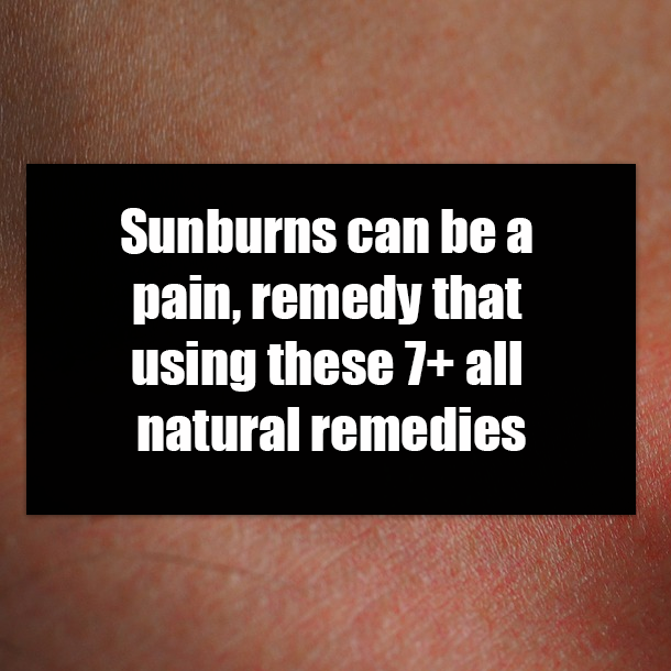 Sunburns can be a pain, remedy that using these 7+ all natural remedies