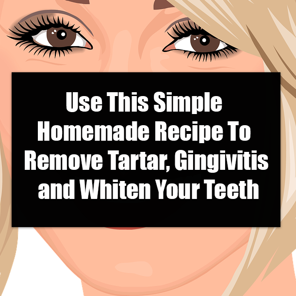 Use This Simple Homemade Recipe To Remove Tartar, Gingivitis and Whiten Your Teeth