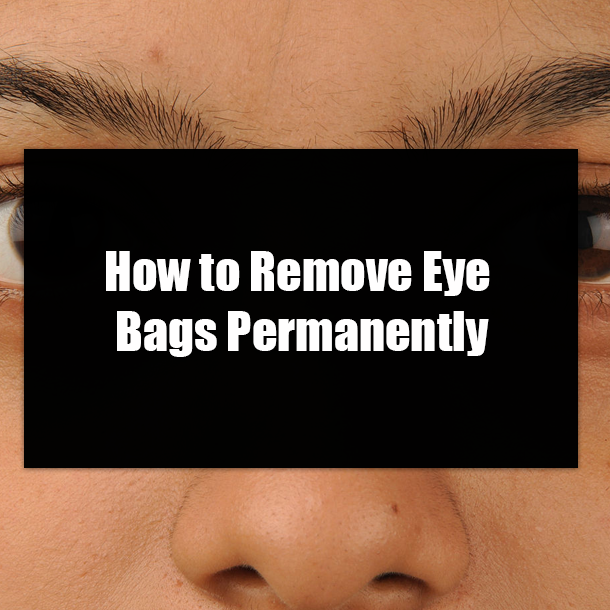 How to Remove Eye Bags Permanently
