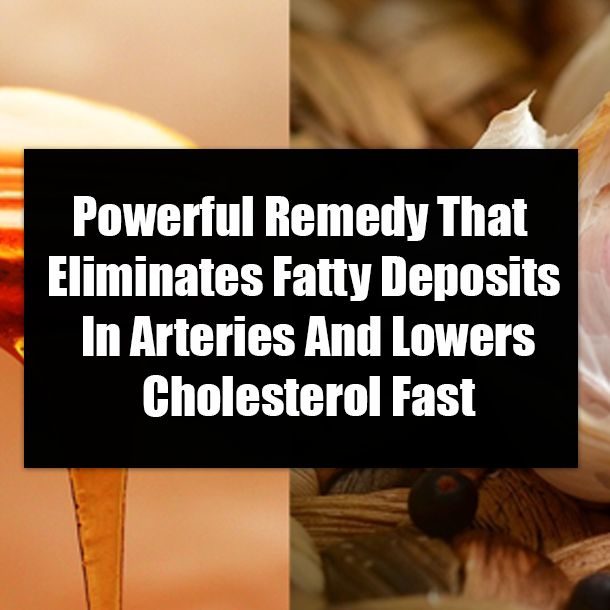 Powerful Remedy That Eliminates Fatty Deposits In Arteries And Lowers Cholesterol Fast