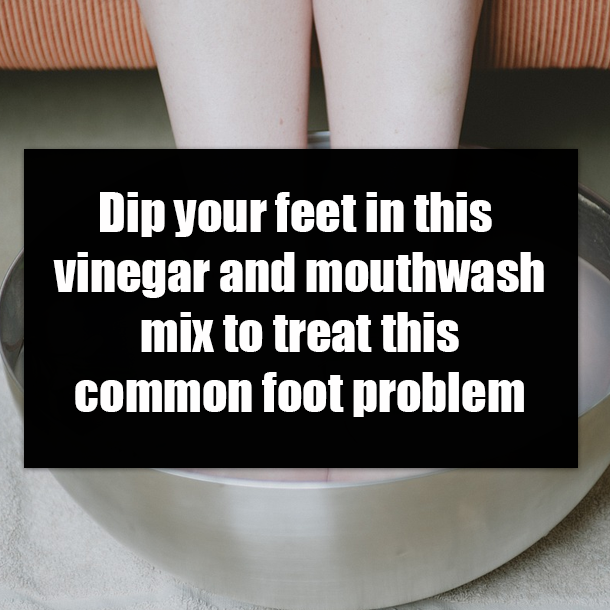Dip your feet in this vinegar and mouthwash mix to treat this common foot problem