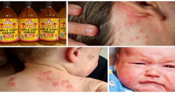 ​How To Use Apple Cider Vinegar To Treat Eczema - picture 2