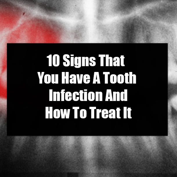 10 Signs That You Have A Tooth Infection And How To Treat It