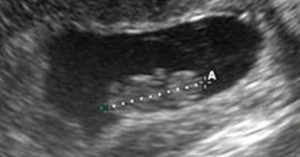 10-Year-Old Goes To The Hospital For Ultrasound, Leaves Doctors Scratching Their Heads - picture 2