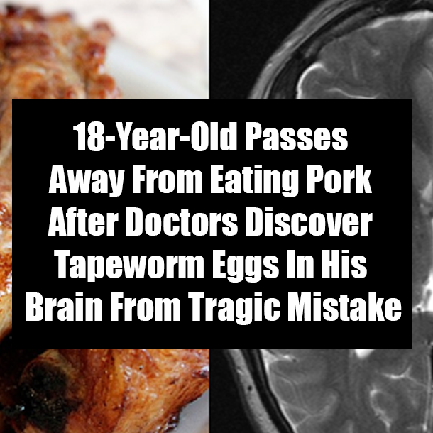 18-Year-Old Passes Away From Eating Pork After Doctors Discover Tapeworm Eggs In His Brain From Tragic Mistake