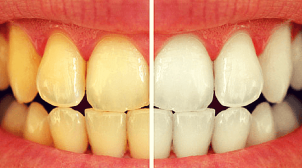 How To Have White Teeth At Home In Just 3 Minutes - picture 2