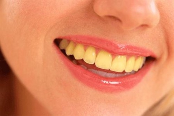 How To Have White Teeth At Home In Just 3 Minutes - picture 3