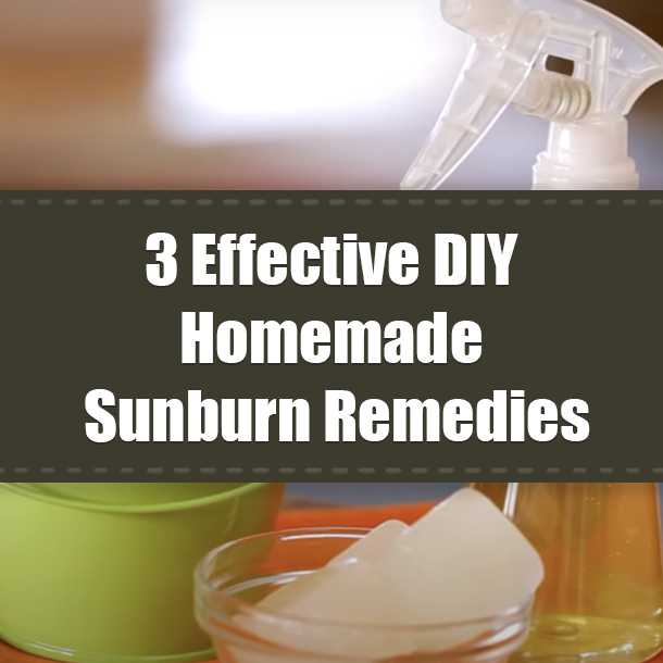 3 Effective DIY Homemade Sunburn Remedies
