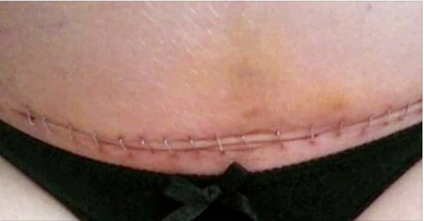 3 Things Everyone Must Learn About Women Who Had C-section - picture 2