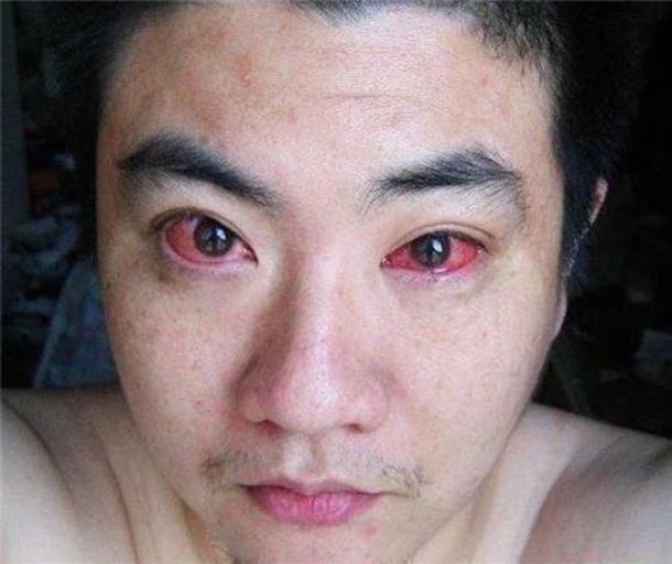 40 Year Old Man Is Diagnosed With Eye Cancer Because He Did This Every Night... - picture 2