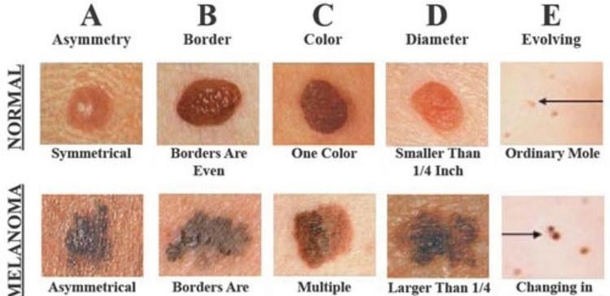 5 Million People Are Treated For Skin Cancer Each Year. This Skin Cancer Detector Could Save Your Life! - picture 2