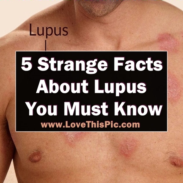 5 Strange And Unusual Facts About Lupus You Should Know