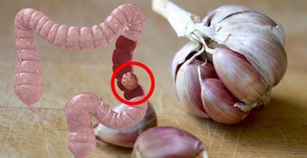 50% Of All Colon Cancer Cases Could Be Prevented If Everybody Did These 9 Things - picture 2