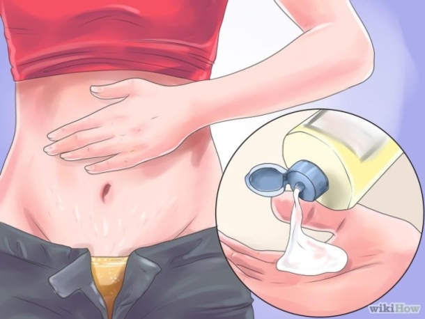 Get Rid Of Stretch Marks RIGHT NOW Using These Methods, They Work! - picture 2