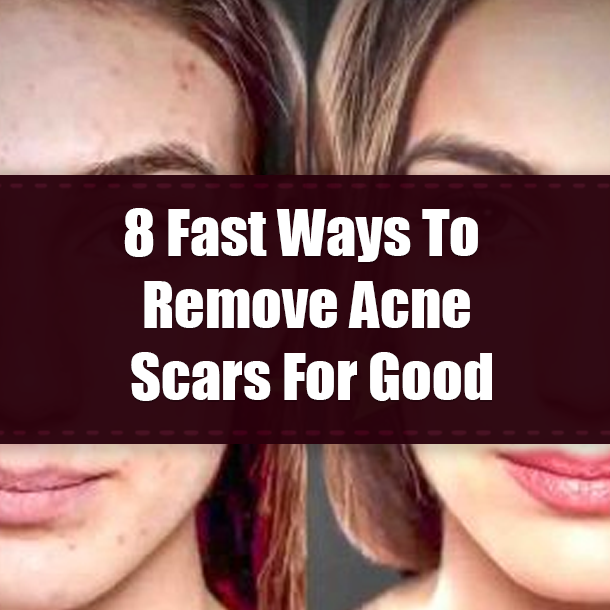 8 Fast Ways To Remove Acne Scars For Good