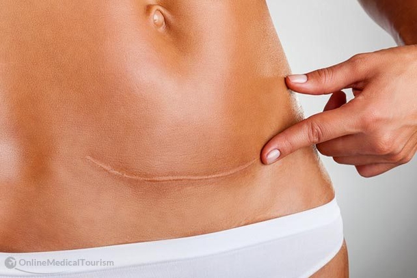 9 Ovarian Cancer Signs All Women Should Know About - picture 4