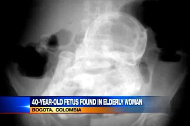 A 44-Year-Old Was Discovered Inside This 88-Year-Old Woman - picture 4