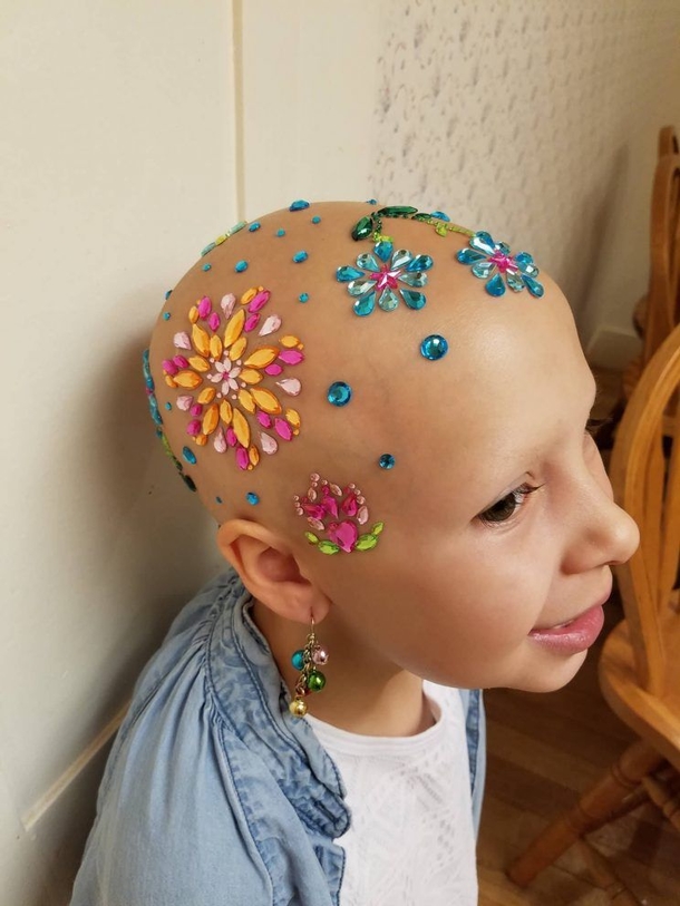 A Little Girl's Hair Falls Out Suddenly. Her Parents Are In Complete Shock & Confusion, When They See A Doctor? She Is Bald - picture 3