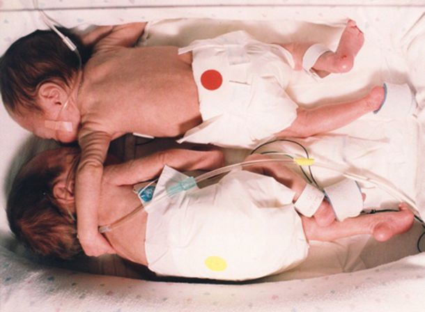 Baby Girl Embraced Dying Twin Sister. What Followed Shocked The World - picture 3