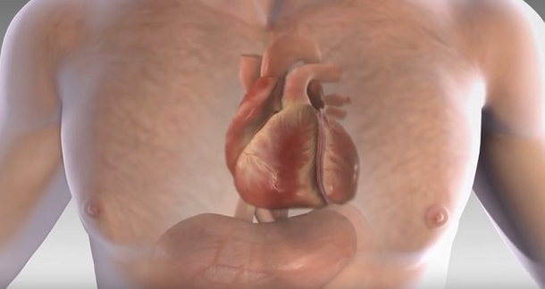 Before A Heart Attack, Your Body Gives You A Warning – These Are The 5 Signs - picture 2