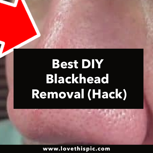 Best DIY Blackhead Removal (Hack)
