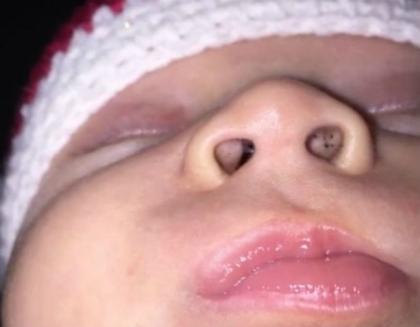 Black Dots In Your Baby’s Nose? Here’s Why You Should Take Immediate Action - picture 2