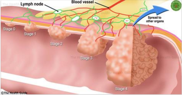 Cancer Dies If You Eat These Foods-You Should Start Eating Them Immediately - picture 2