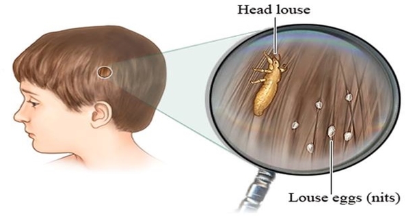 CHEAP WAY TO GET RID OF HEAD LICE THAT DOCTORS WON’T TELL YOU - picture 2