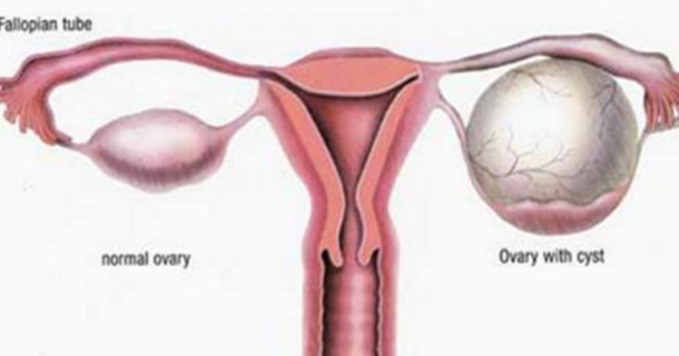Clean The Ovary Cysts With The Best Recipes! - picture 2