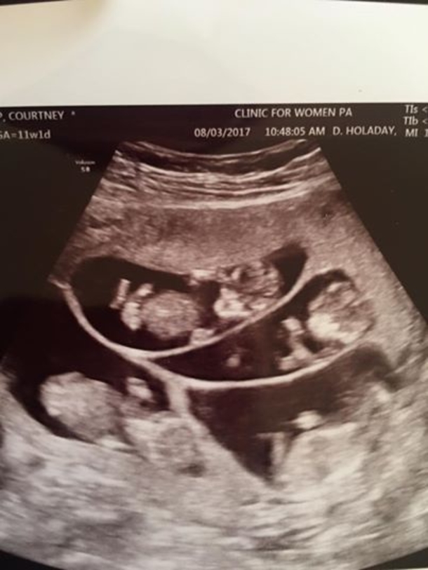Couple Devastated After Miscarriages, Once They See Ultrasound; Their Hearts Drop - picture 3