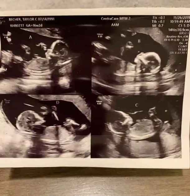 Couple welcomes rare identical quadruplet girls - Truly Four of a kind! - picture 2