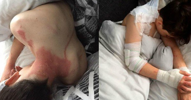 Dad Notices Weird Line Down Son’s Back, Two Days Later He’s in Horrible Pain - picture 2