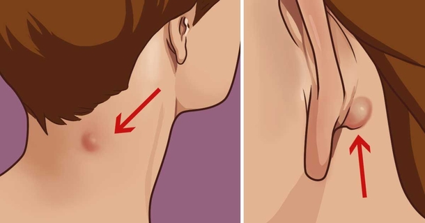 Do You Have A Lump On Your Neck, Back Or Behind Your Ear? Here's What You Need To Know - picture 2