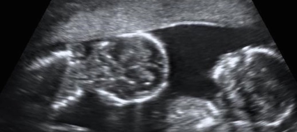 Doctors Give This 15 Year Old Some Bad News: He Is Carrying A Baby Inside Him! - picture 2