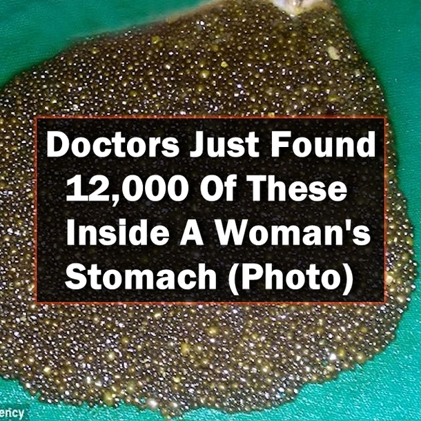 Doctors Just Found 12,000 Of These Inside A Woman's Stomach (Photo)