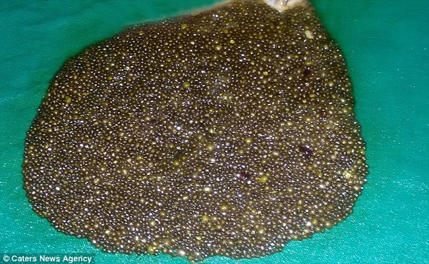 Doctors Just Found 12,000 Of These Inside A Woman's Stomach (Photo) - picture 3