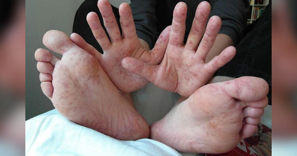 Doctors Warn HFM Disease Is On The Rise, Spreading Quickly. What They Say You Need To Know - picture 2