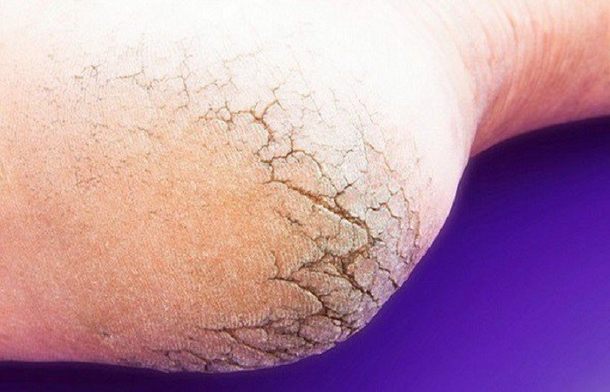 Don’t Waste Money On Pedicures Anymore – With Just Two Kitchen Ingredients, Your Feet Will Look Better Than They Have In A Long Time! - picture 2