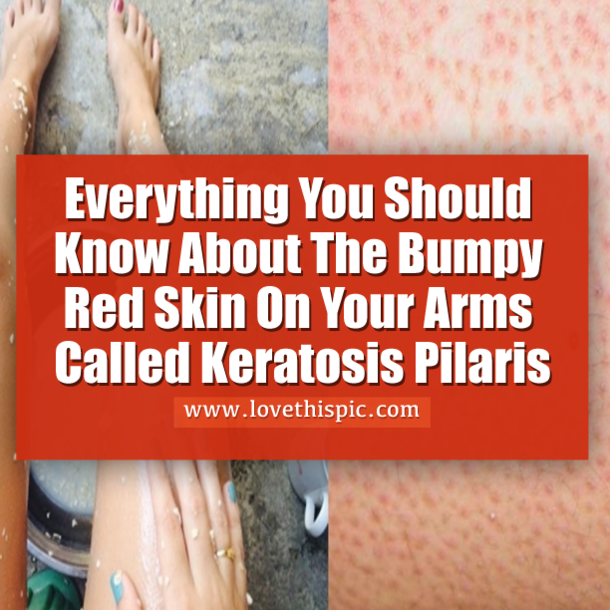 Everything You Should Know About The Bumpy Red Skin On Your Arms Called Keratosis Pilaris