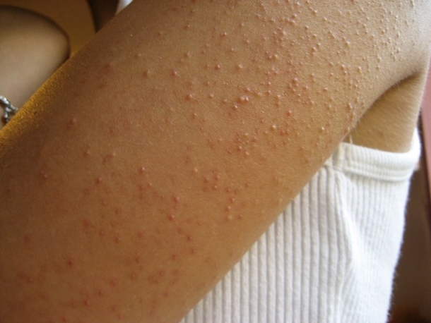 Everything You Should Know About The Bumpy Red Skin On Your Arms Called Keratosis Pilaris - picture 2