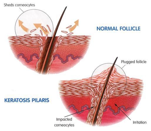 Everything You Should Know About The Bumpy Red Skin On Your Arms Called Keratosis Pilaris - picture 3